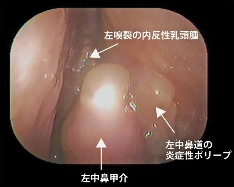 内反性乳頭腫　（inverted　papilloma）