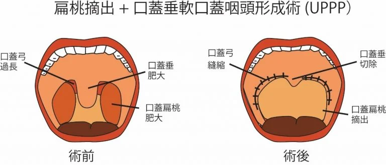 UPPP（Uvulopalatopharyngoplasty、口蓋垂軟口蓋咽頭形成術）
