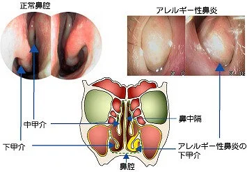 アレルギー性鼻炎の鼻腔所見