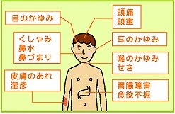 アレルギー性鼻炎の症状