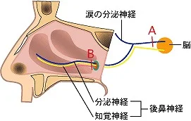 鼻内後鼻神経凍結術