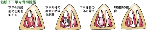 粘膜下下甲介骨切除術