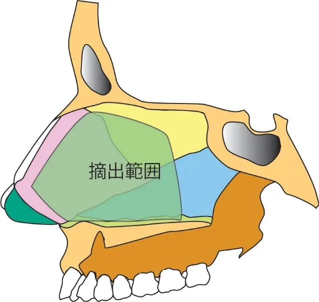 以前の手術