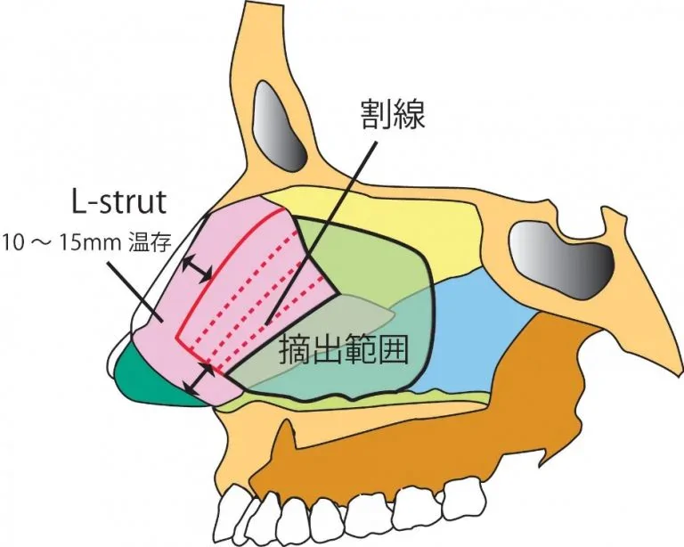 近年の鼻中隔矯正術(図4)