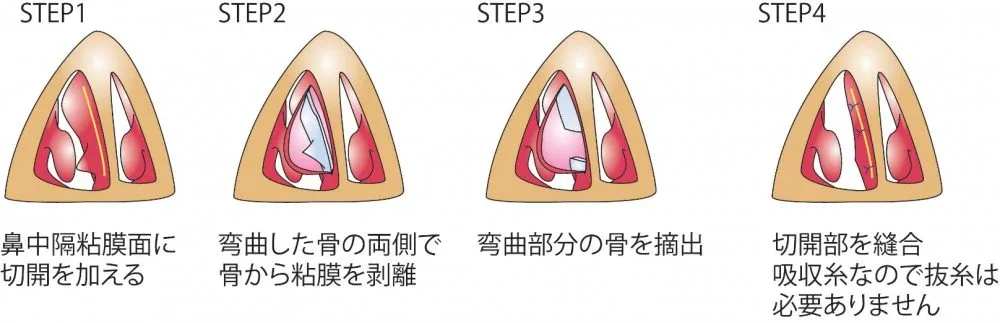 実際の手術方法