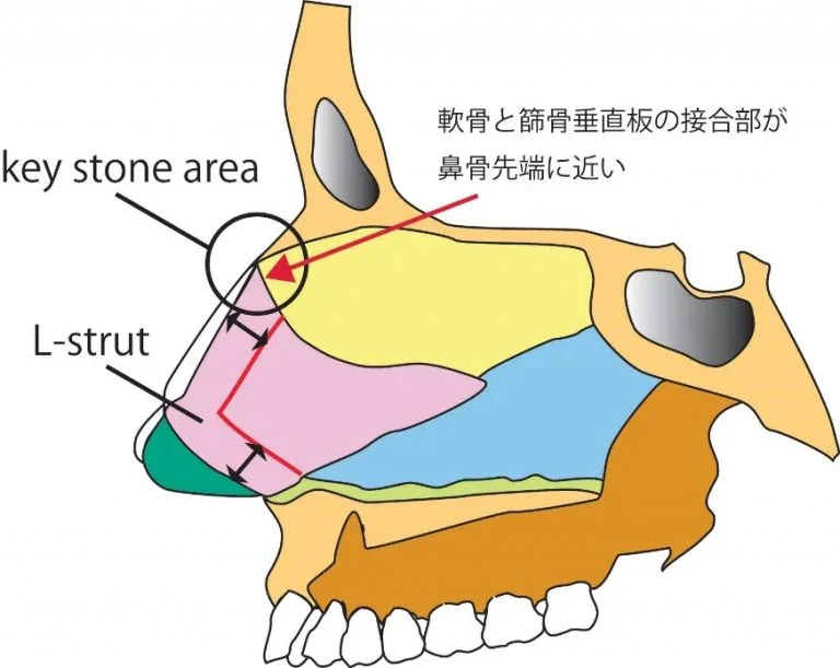 鞍鼻（鼻すじの変形）に注意が必要な場合（図5）