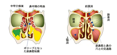 鼻閉・鼻づまり