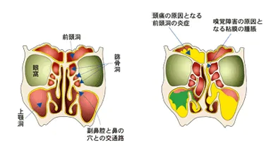 嗅覚障害