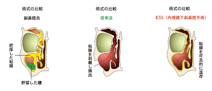 従来の手術療法