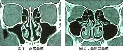 鼻腔