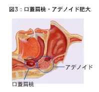 口蓋扁桃・アデノイド